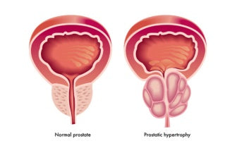 Prostate Care